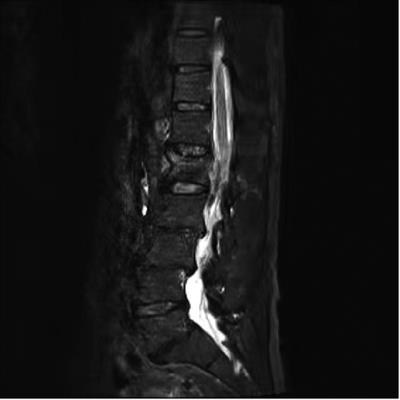 Acute abdomen after vertebroplasty-A rare complication